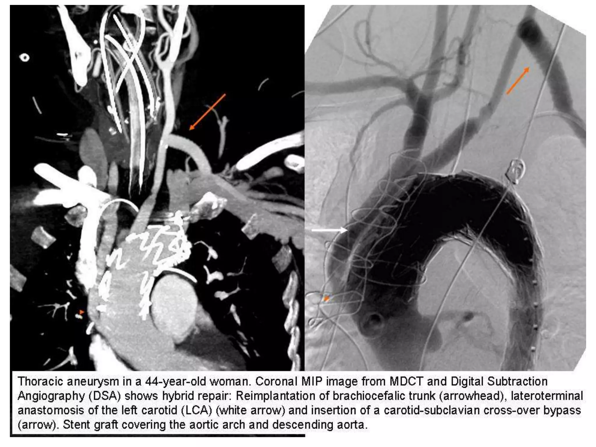 Presentation1, radiological imaging of thoracic aortic aneurysm. | PPTX