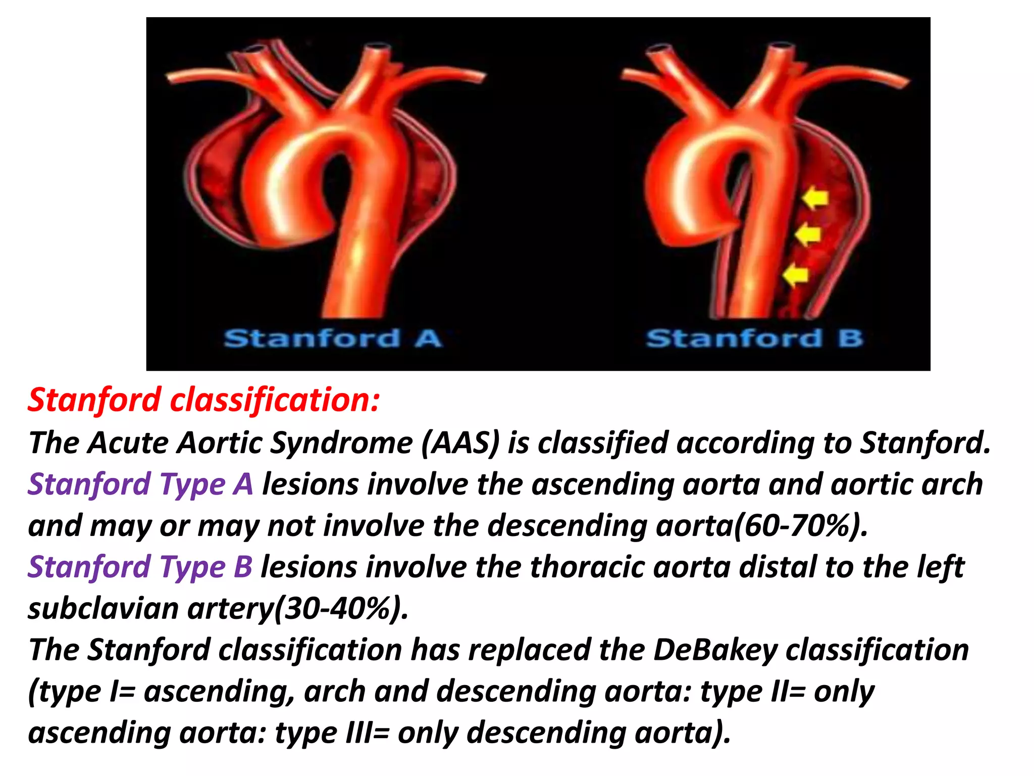 Sts Aortic Classification Presentation1, radiological imaging of thoracic aortic aneurysm. | PPTX