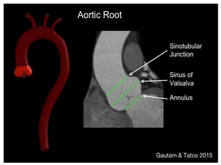 Presentation1, radiological imaging of thoracic aortic aneurysm. | PPTX