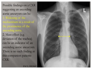 Presentation1, radiological imaging of thoracic aortic aneurysm. | PPTX