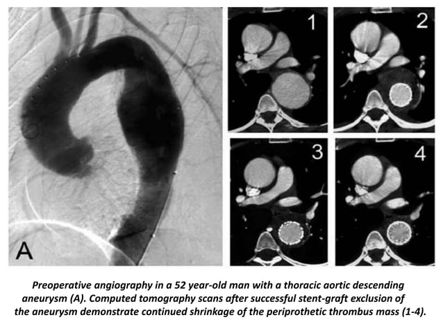 Presentation1, radiological imaging of thoracic aortic aneurysm. | PPTX