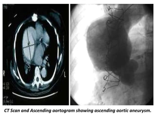 Presentation1, radiological imaging of thoracic aortic aneurysm. | PPTX