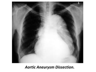 Thoracic Aortic Aneurysm Xray