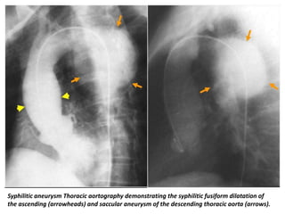 Thoracic Aortic Aneurysm Xray