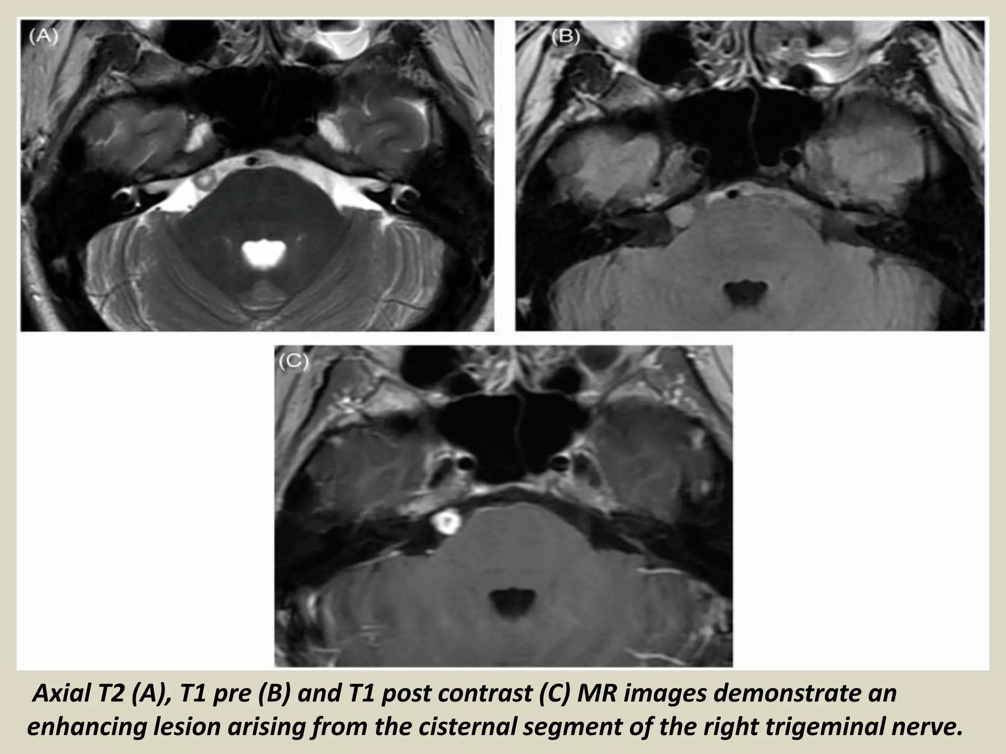 Presentation1, radiological imaging of trigeminal schwanoma. | PPTX