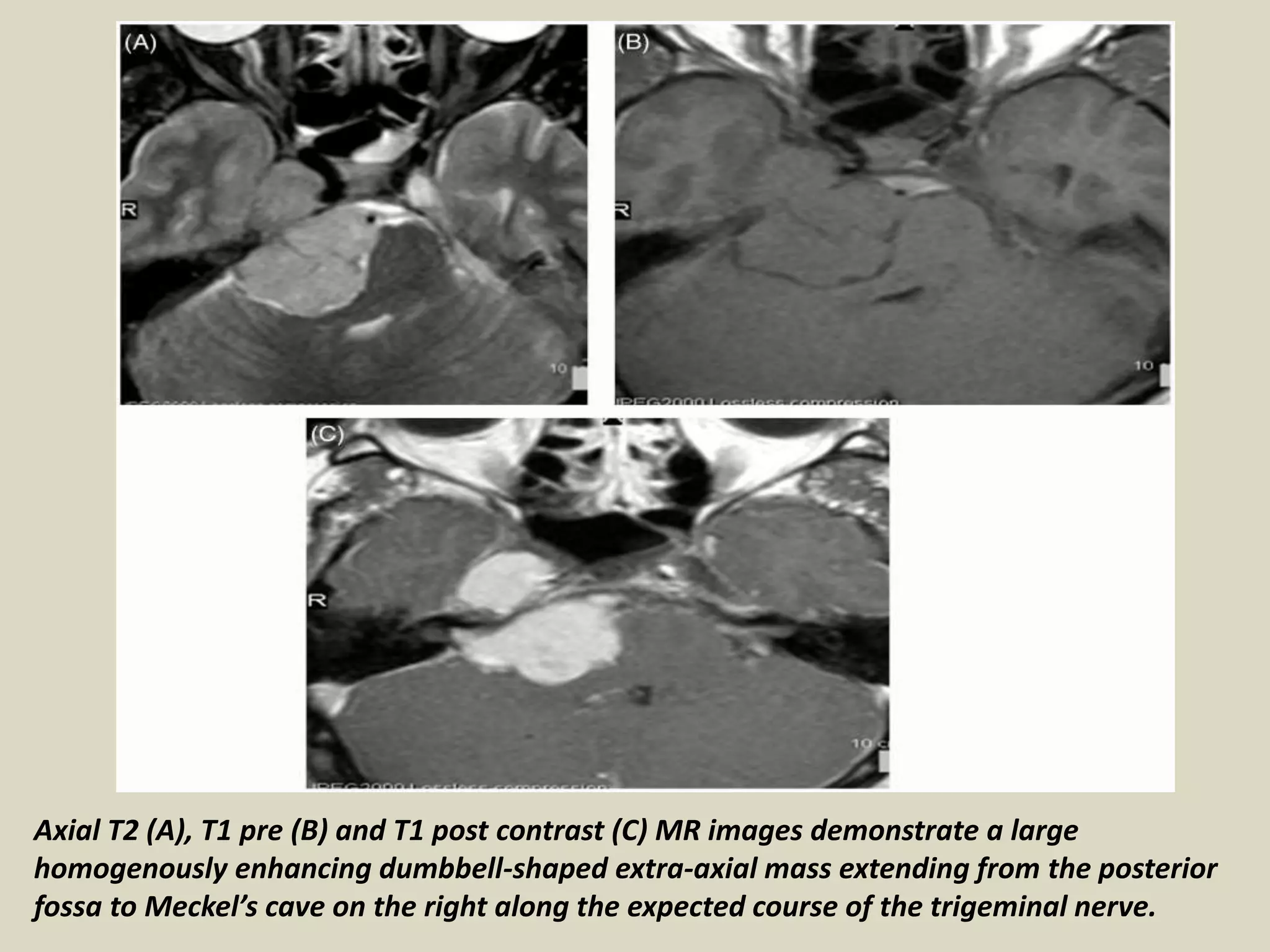 Presentation1, radiological imaging of trigeminal schwanoma. | PPTX
