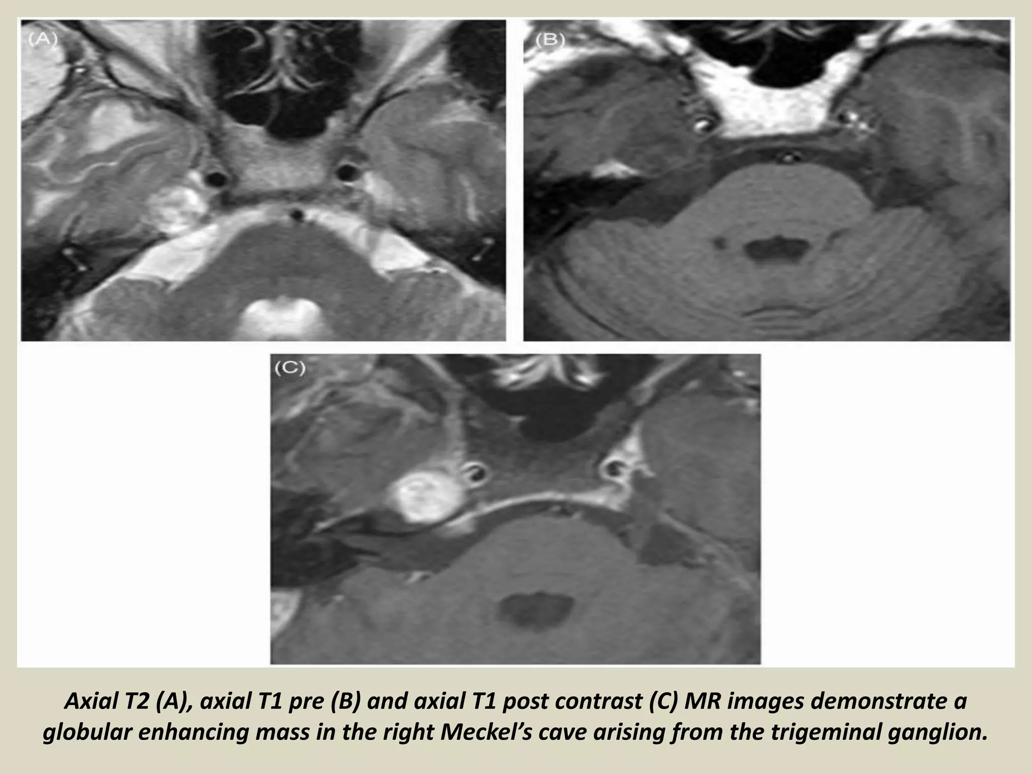 Presentation1, radiological imaging of trigeminal schwanoma. | PPTX