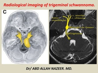 Dr/ ABD ALLAH NAZEER. MD.
Radiological imaging of trigeminal schwannoma.
 