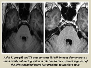 Presentation1, radiological imaging of trigeminal schwanoma. | PPTX