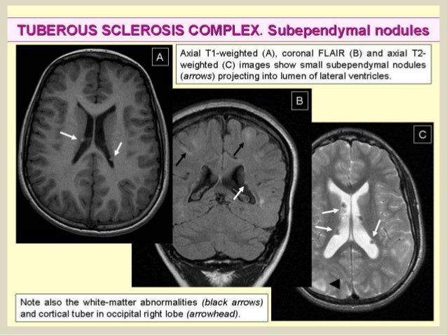 Presentation1, radiological imaging of tuberous sclerosis.