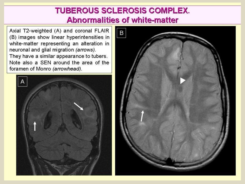 Presentation1, radiological imaging of tuberous sclerosis.