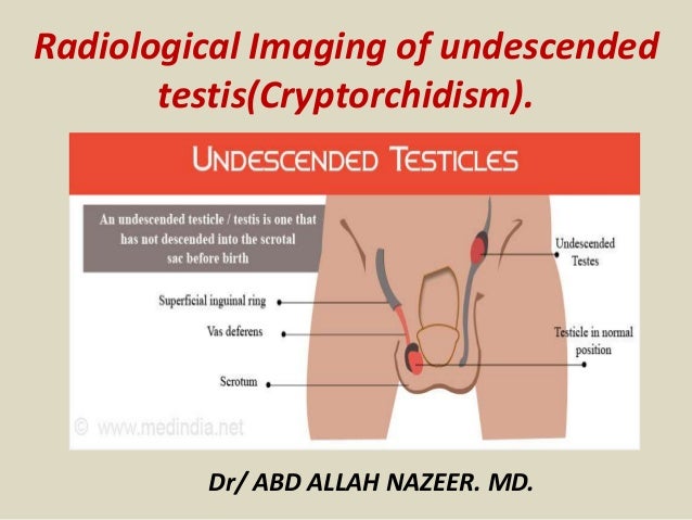 Presentation1, radiological imaging of undescended testis.