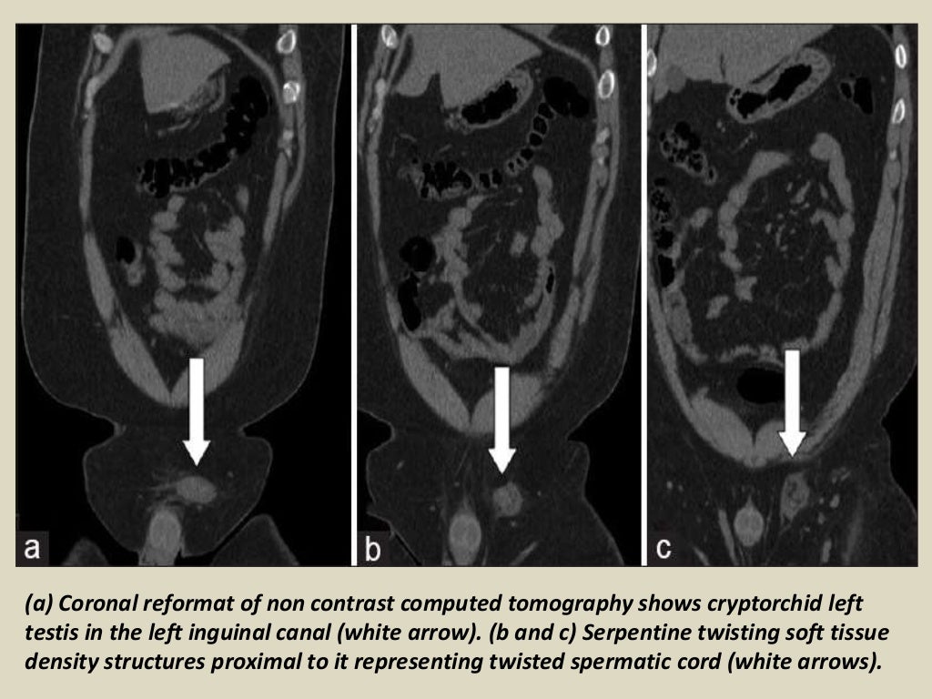 Presentation1, radiological imaging of undescended testis.