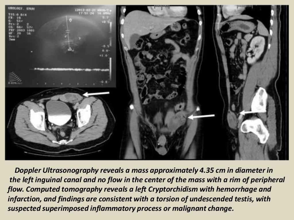 Presentation1, radiological imaging of undescended testis.