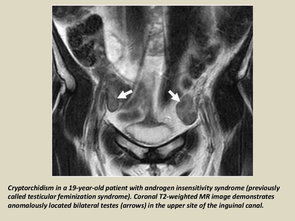 Presentation1, radiological imaging of undescended testis.