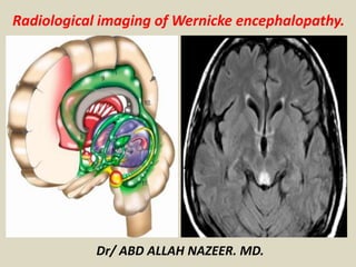 Radiological imaging of Wernicke encephalopathy.
Dr/ ABD ALLAH NAZEER. MD.
 
