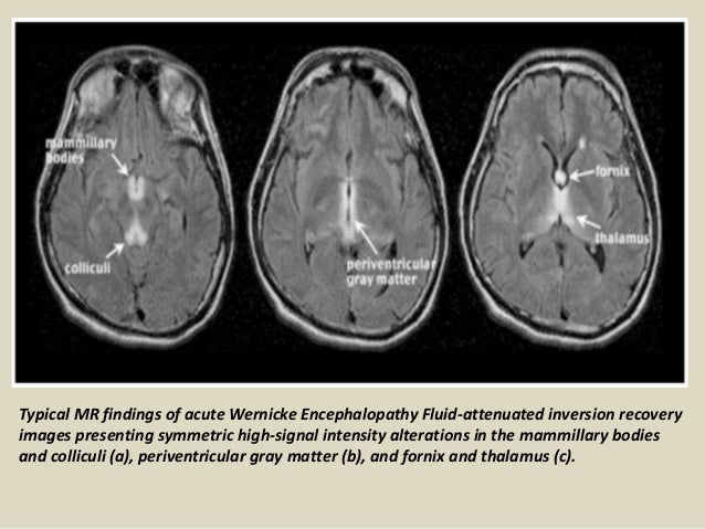 Wernicke Encephalopathy MRI