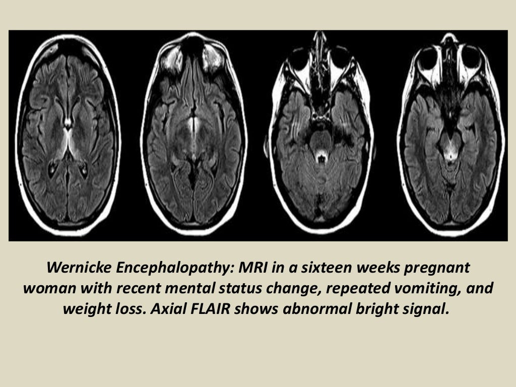 Presentation1, radiological imaging of wernicke encephalopathy.