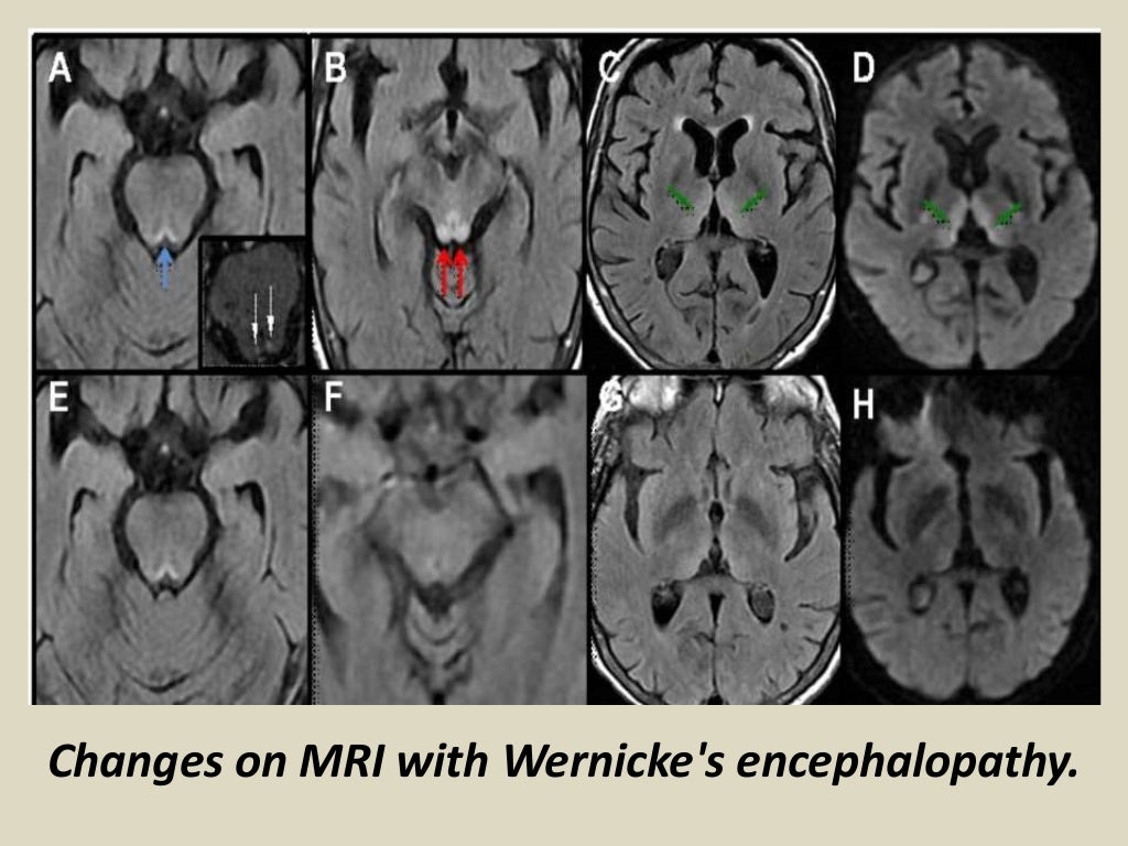 Presentation1, radiological imaging of wernicke encephalopathy.
