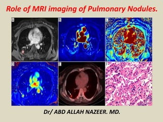 Dr/ ABD ALLAH NAZEER. MD.
Role of MRI imaging of Pulmonary Nodules.
 