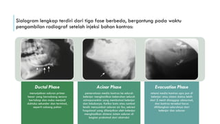 Presentation1 sialolithiasis presentation | PPTX