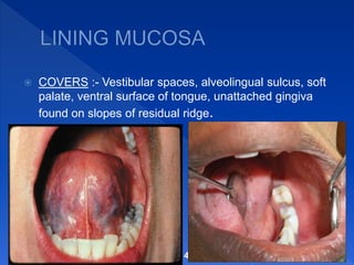  COVERS :- Vestibular spaces, alveolingual sulcus, soft
palate, ventral surface of tongue, unattached gingiva
found on slopes of residual ridge.
14
 