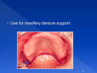  Use for maxillary denture support.
20
 