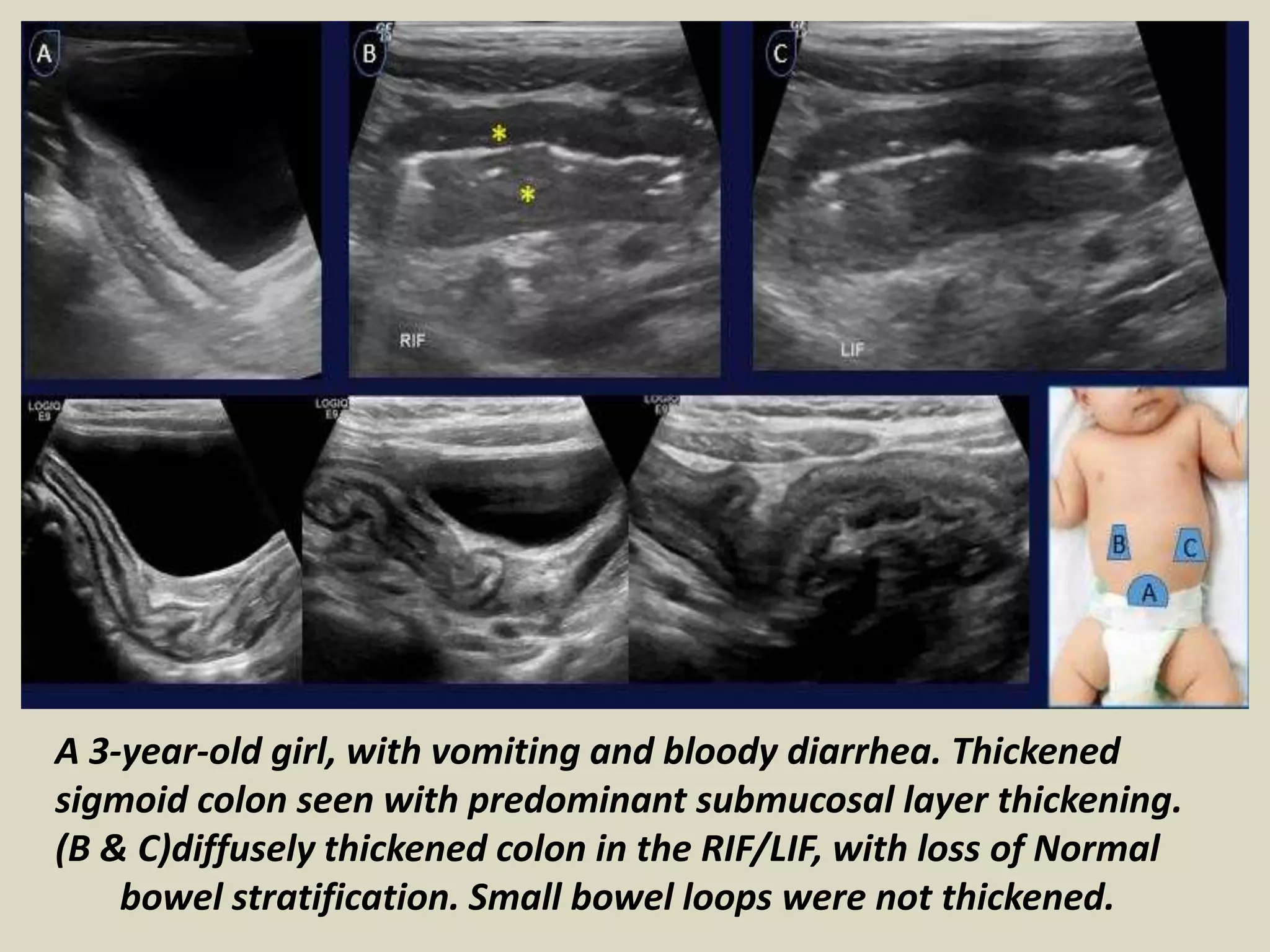 Colon In Loop Normal Presentation1, ultrasound of the bowel loops and the lymph nodes. | PPTX