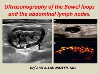 Ultrasonography of the Bowel loops
and the abdominal lymph nodes.
Dr/ ABD ALLAH NAZEER. MD.
 