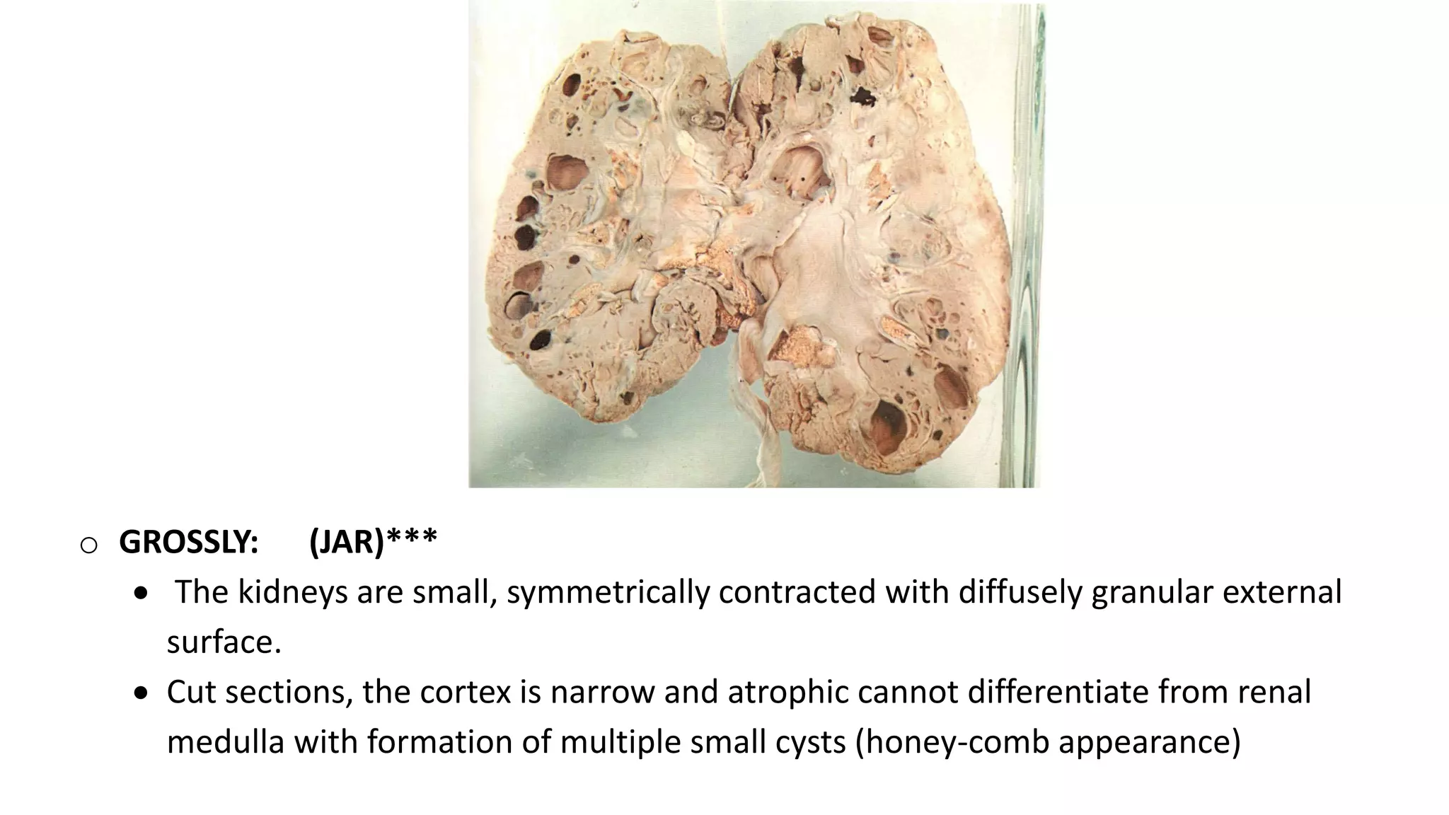 o GROSSLY: (JAR)***
 The kidneys are small, symmetrically contracted with diffusely granular external
surface.
 Cut sections, the cortex is narrow and atrophic cannot differentiate from renal
medulla with formation of multiple small cysts (honey-comb appearance)
 