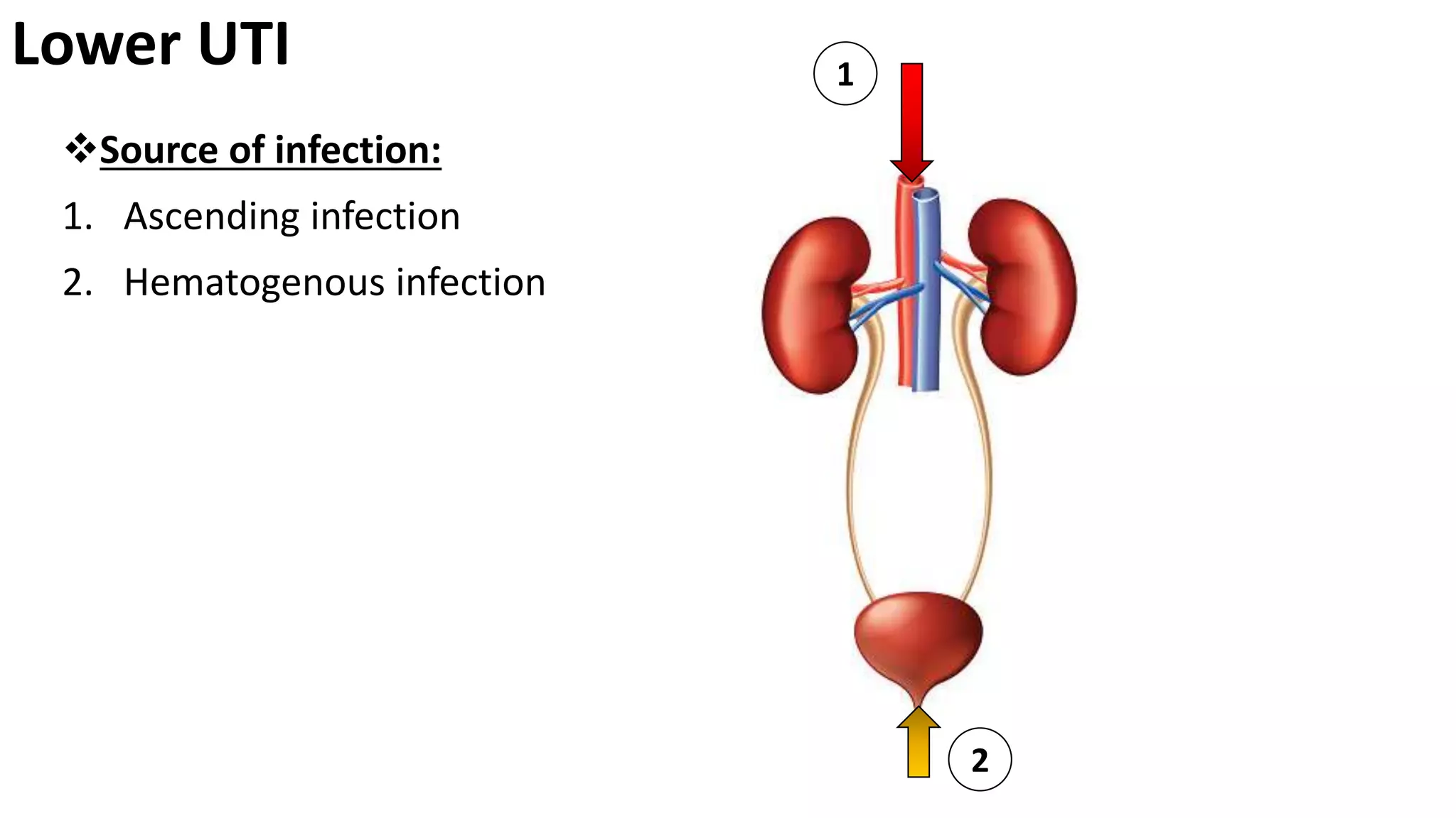 Lower UTI
Source of infection:
1. Ascending infection
2. Hematogenous infection
1
2
 