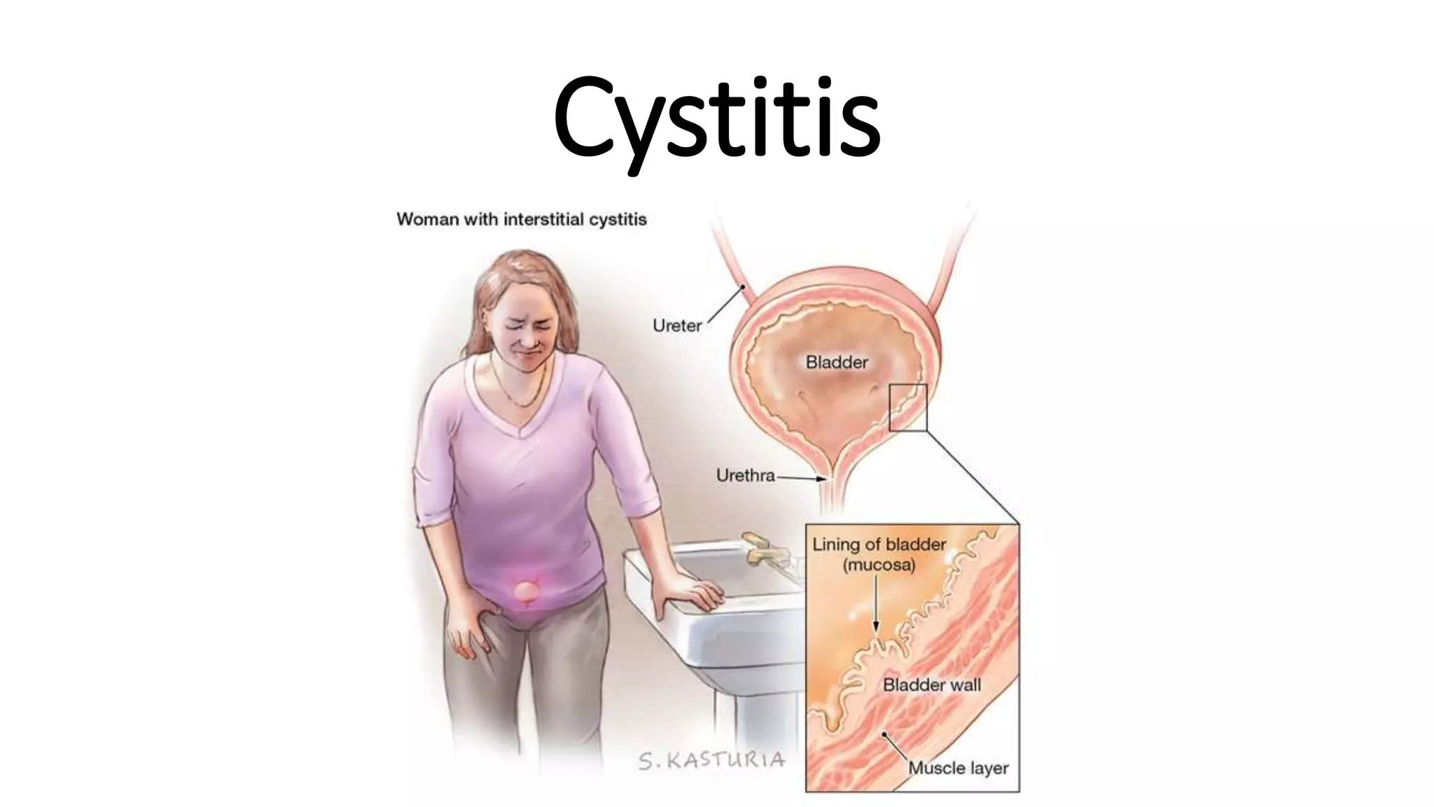 Cystitis
 