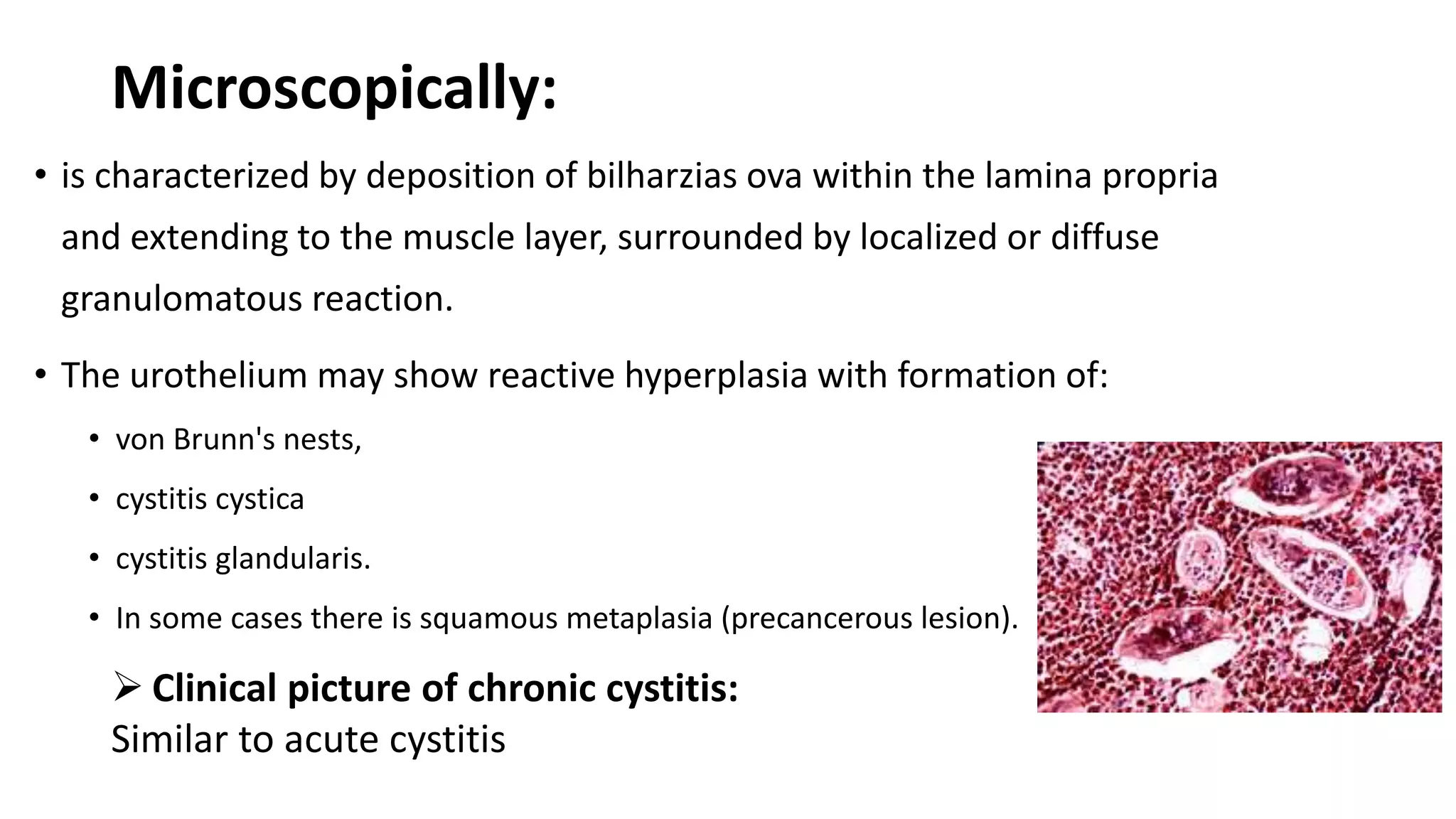 Microscopically:
• is characterized by deposition of bilharzias ova within the lamina propria
and extending to the muscle layer, surrounded by localized or diffuse
granulomatous reaction.
• The urothelium may show reactive hyperplasia with formation of:
• von Brunn's nests,
• cystitis cystica
• cystitis glandularis.
• In some cases there is squamous metaplasia (precancerous lesion).
 Clinical picture of chronic cystitis:
Similar to acute cystitis
 