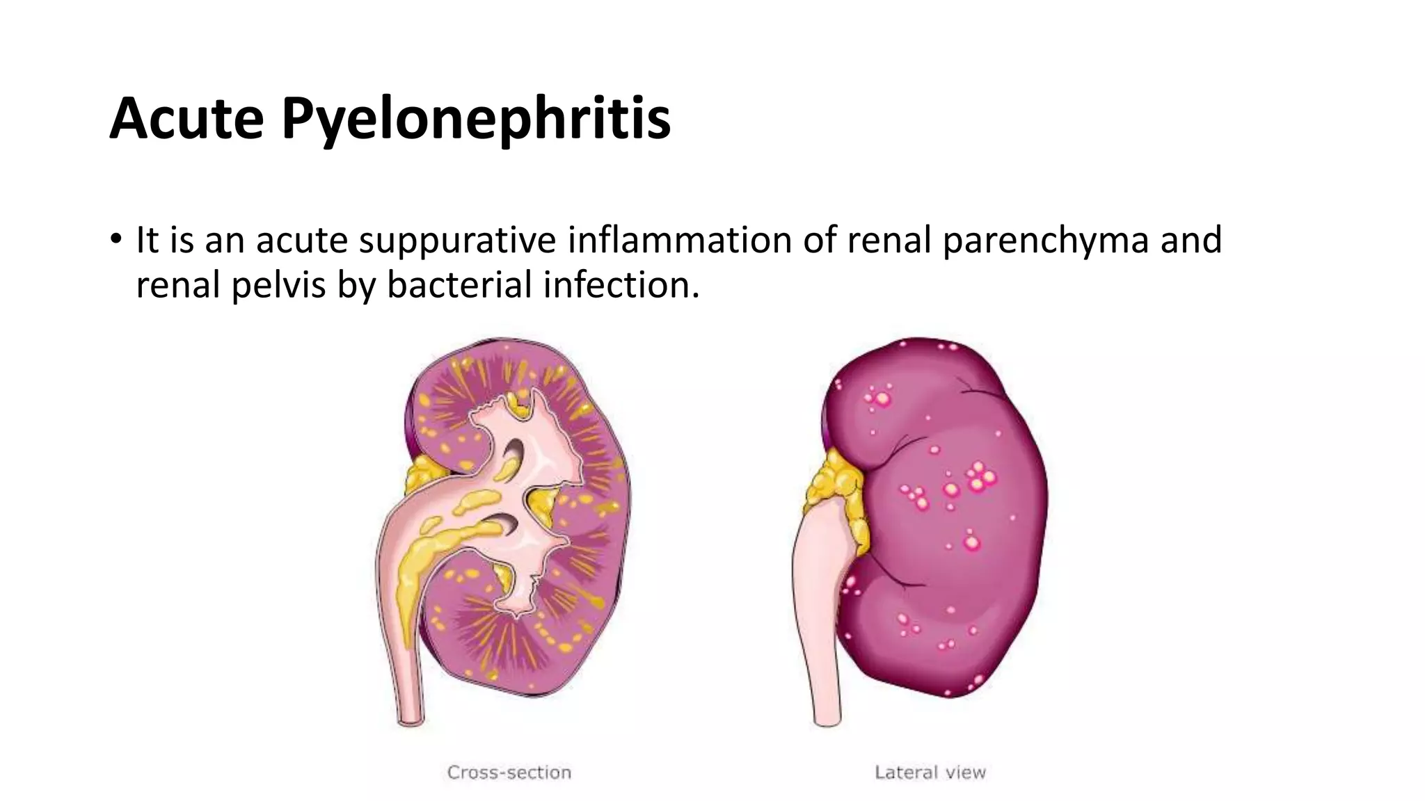 Acute Pyelonephritis
• It is an acute suppurative inflammation of renal parenchyma and
renal pelvis by bacterial infection.
 