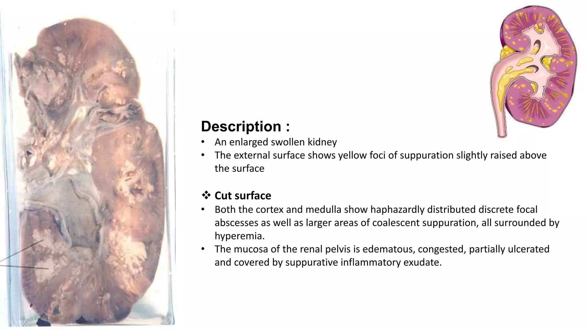 Description :
• An enlarged swollen kidney
• The external surface shows yellow foci of suppuration slightly raised above
the surface
 Cut surface
• Both the cortex and medulla show haphazardly distributed discrete focal
abscesses as well as larger areas of coalescent suppuration, all surrounded by
hyperemia.
• The mucosa of the renal pelvis is edematous, congested, partially ulcerated
and covered by suppurative inflammatory exudate.
 