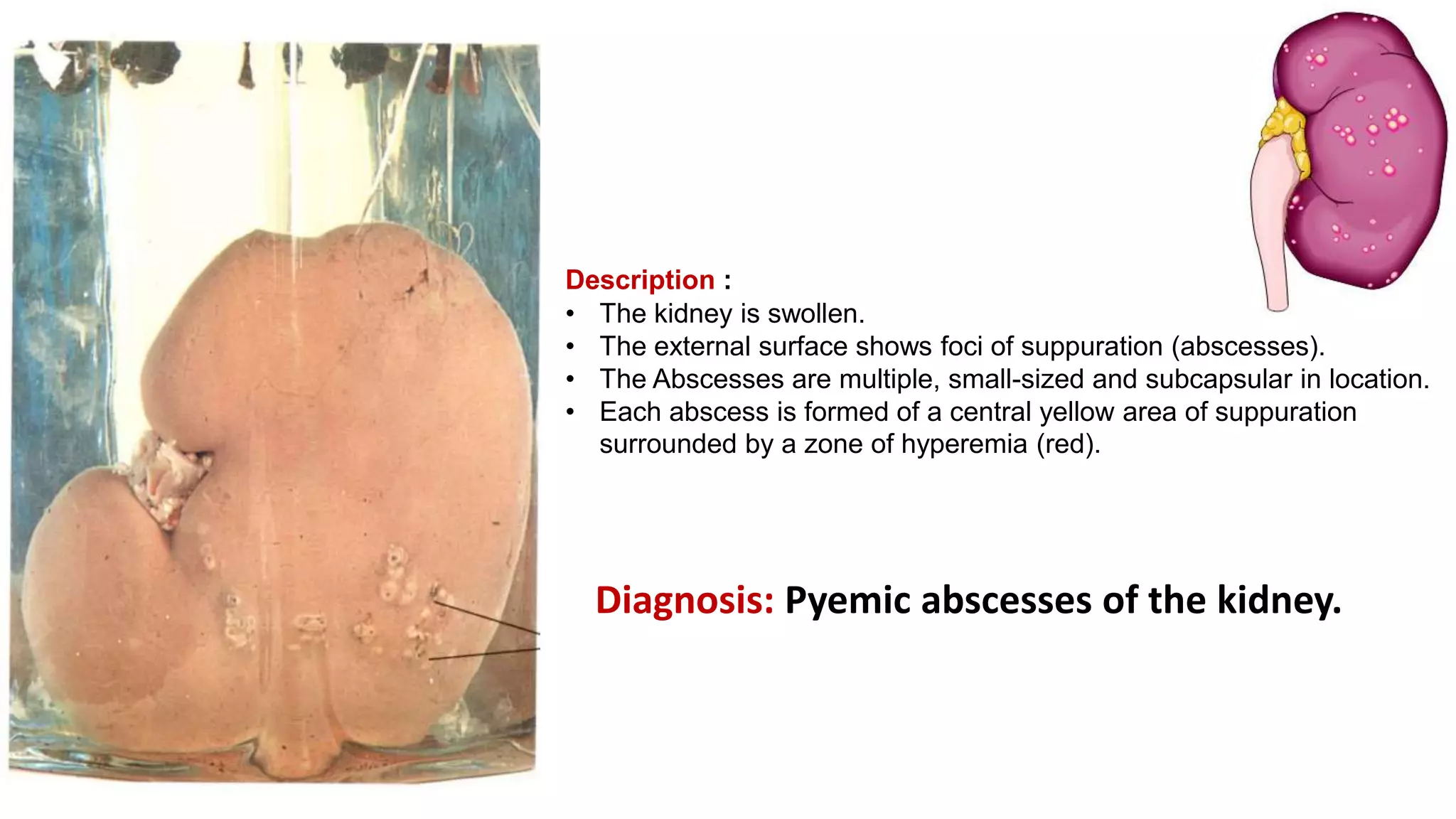 Description :
• The kidney is swollen.
• The external surface shows foci of suppuration (abscesses).
• The Abscesses are multiple, small-sized and subcapsular in location.
• Each abscess is formed of a central yellow area of suppuration
surrounded by a zone of hyperemia (red).
Diagnosis: Pyemic abscesses of the kidney.
 