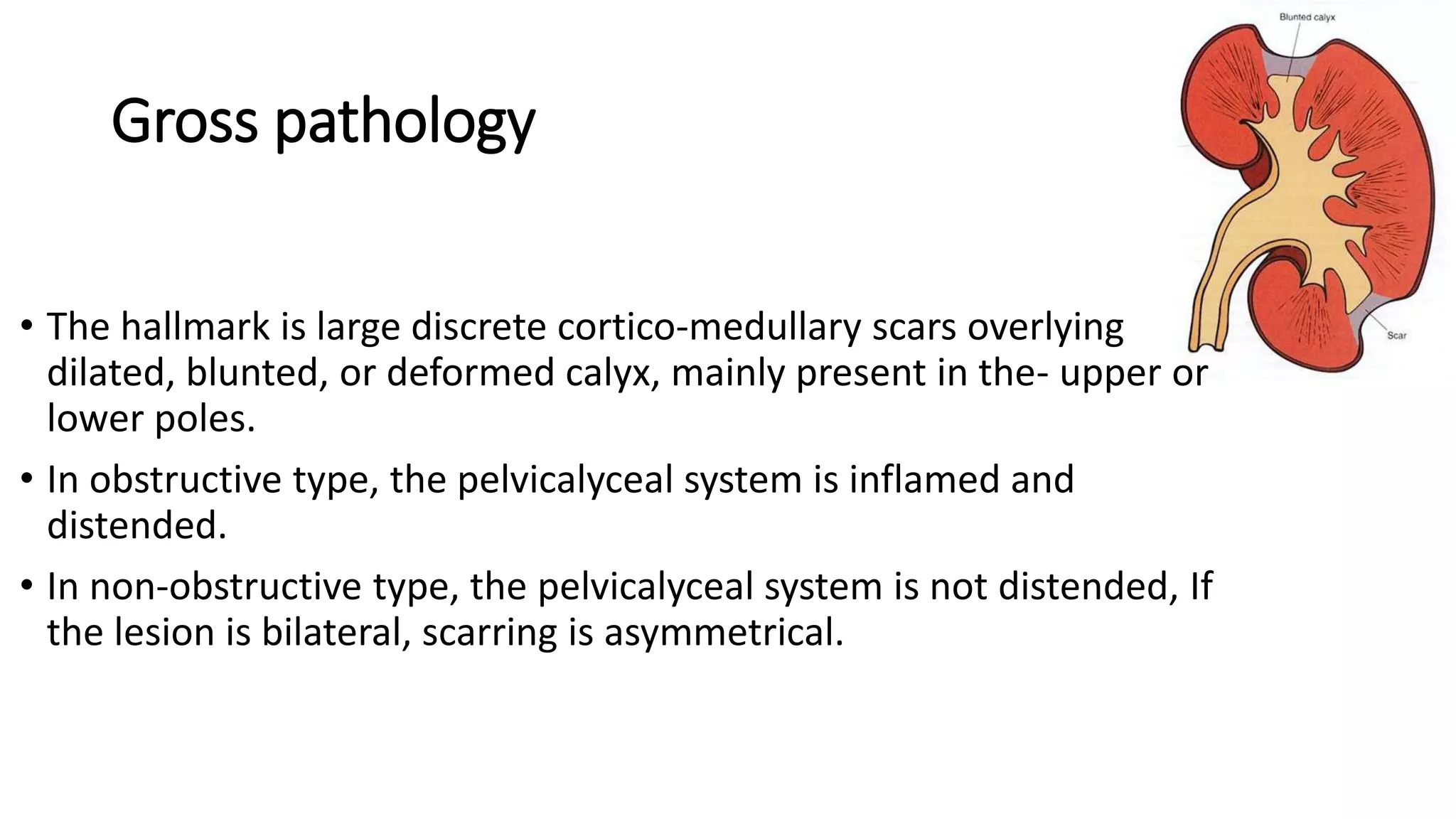 Gross pathology
• The hallmark is large discrete cortico-medullary scars overlying
dilated, blunted, or deformed calyx, mainly present in the- upper or
lower poles.
• In obstructive type, the pelvicalyceal system is inflamed and
distended.
• In non-obstructive type, the pelvicalyceal system is not distended, If
the lesion is bilateral, scarring is asymmetrical.
 