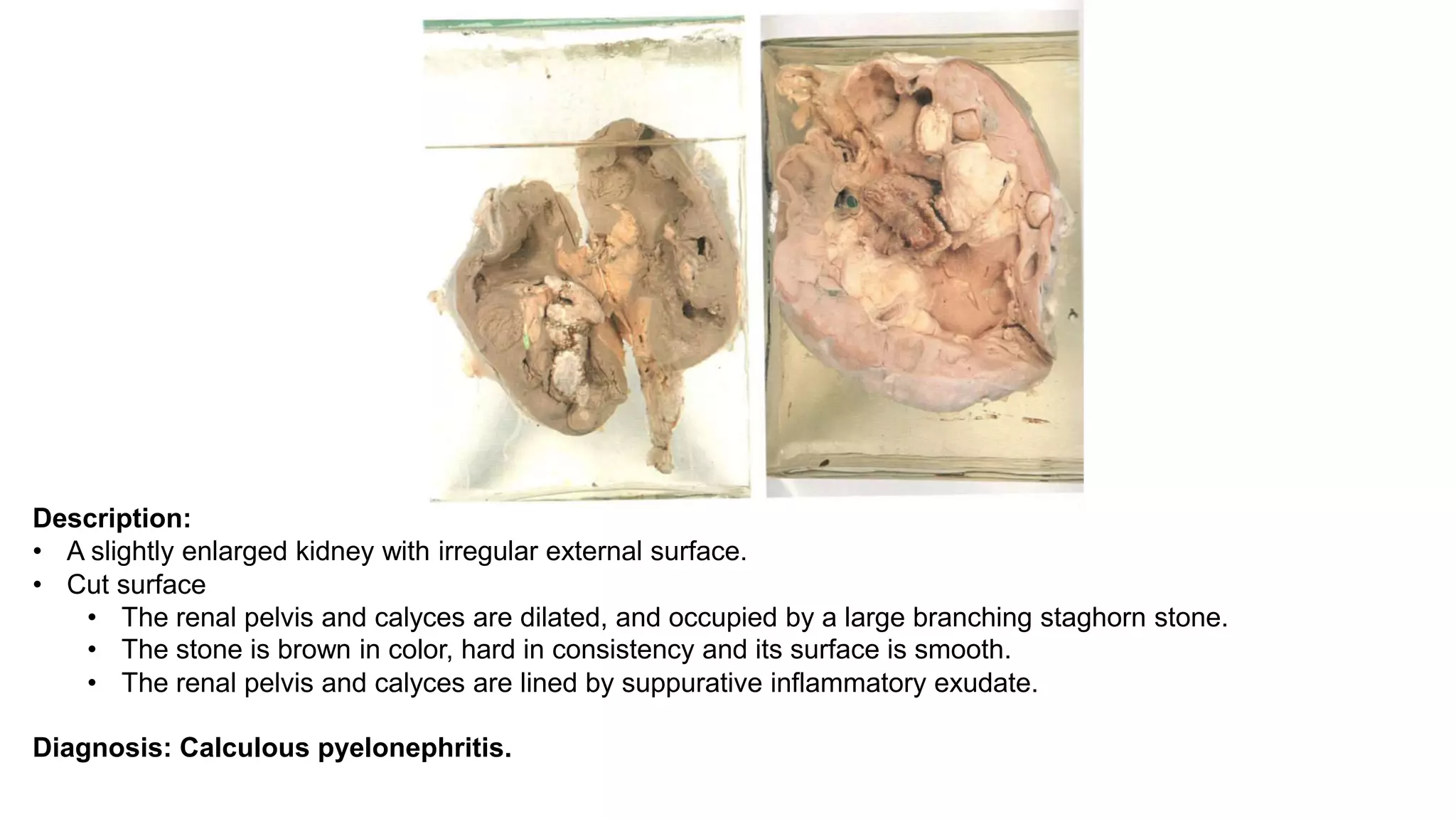 Description:
• A slightly enlarged kidney with irregular external surface.
• Cut surface
• The renal pelvis and calyces are dilated, and occupied by a large branching staghorn stone.
• The stone is brown in color, hard in consistency and its surface is smooth.
• The renal pelvis and calyces are lined by suppurative inflammatory exudate.
Diagnosis: Calculous pyelonephritis.
 