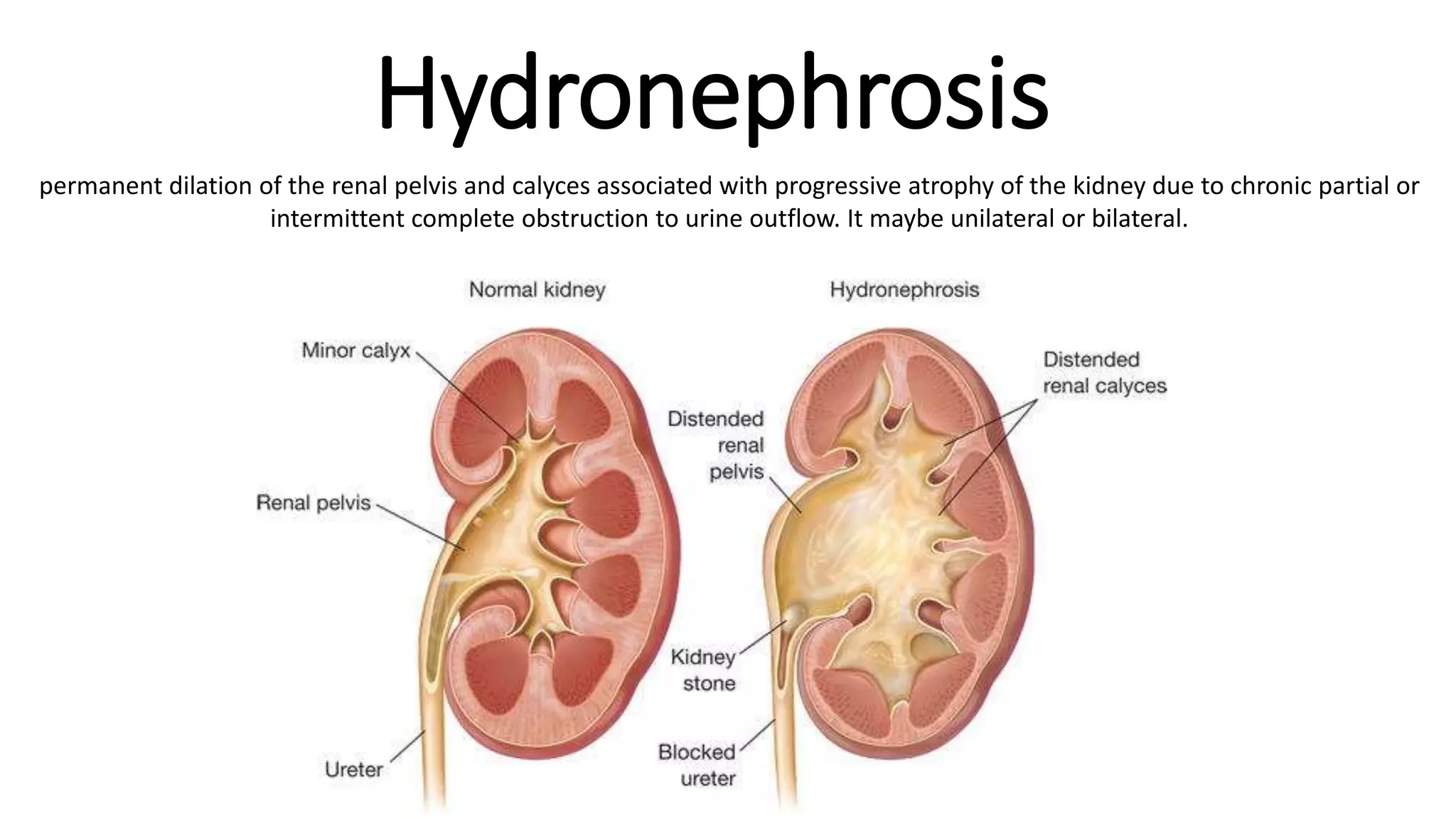 Hydronephrosis
permanent dilation of the renal pelvis and calyces associated with progressive atrophy of the kidney due to chronic partial or
intermittent complete obstruction to urine outflow. It maybe unilateral or bilateral.
 