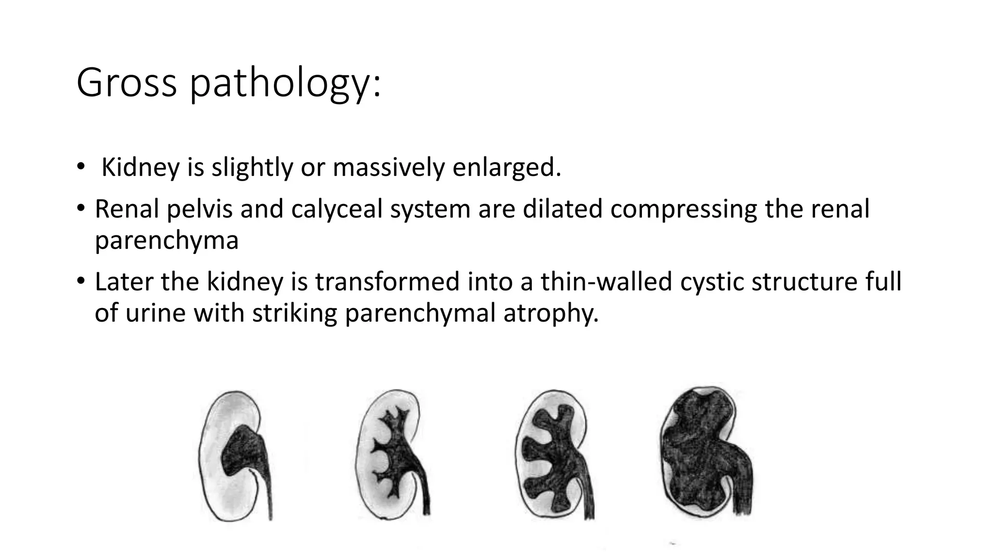 Gross pathology:
• Kidney is slightly or massively enlarged.
• Renal pelvis and calyceal system are dilated compressing the renal
parenchyma
• Later the kidney is transformed into a thin-walled cystic structure full
of urine with striking parenchymal atrophy.
 