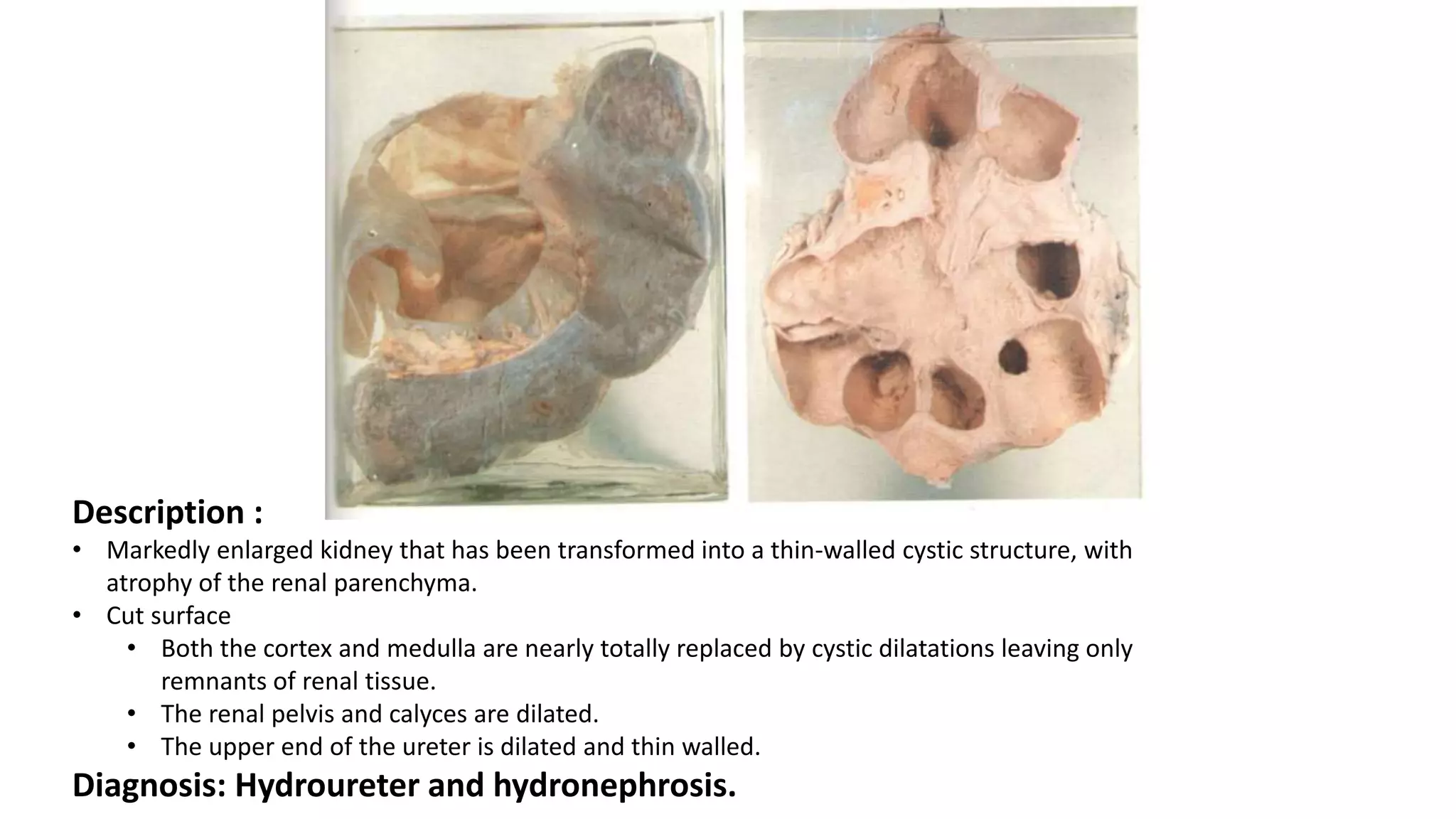 Description :
• Markedly enlarged kidney that has been transformed into a thin-walled cystic structure, with
atrophy of the renal parenchyma.
• Cut surface
• Both the cortex and medulla are nearly totally replaced by cystic dilatations leaving only
remnants of renal tissue.
• The renal pelvis and calyces are dilated.
• The upper end of the ureter is dilated and thin walled.
Diagnosis: Hydroureter and hydronephrosis.
 