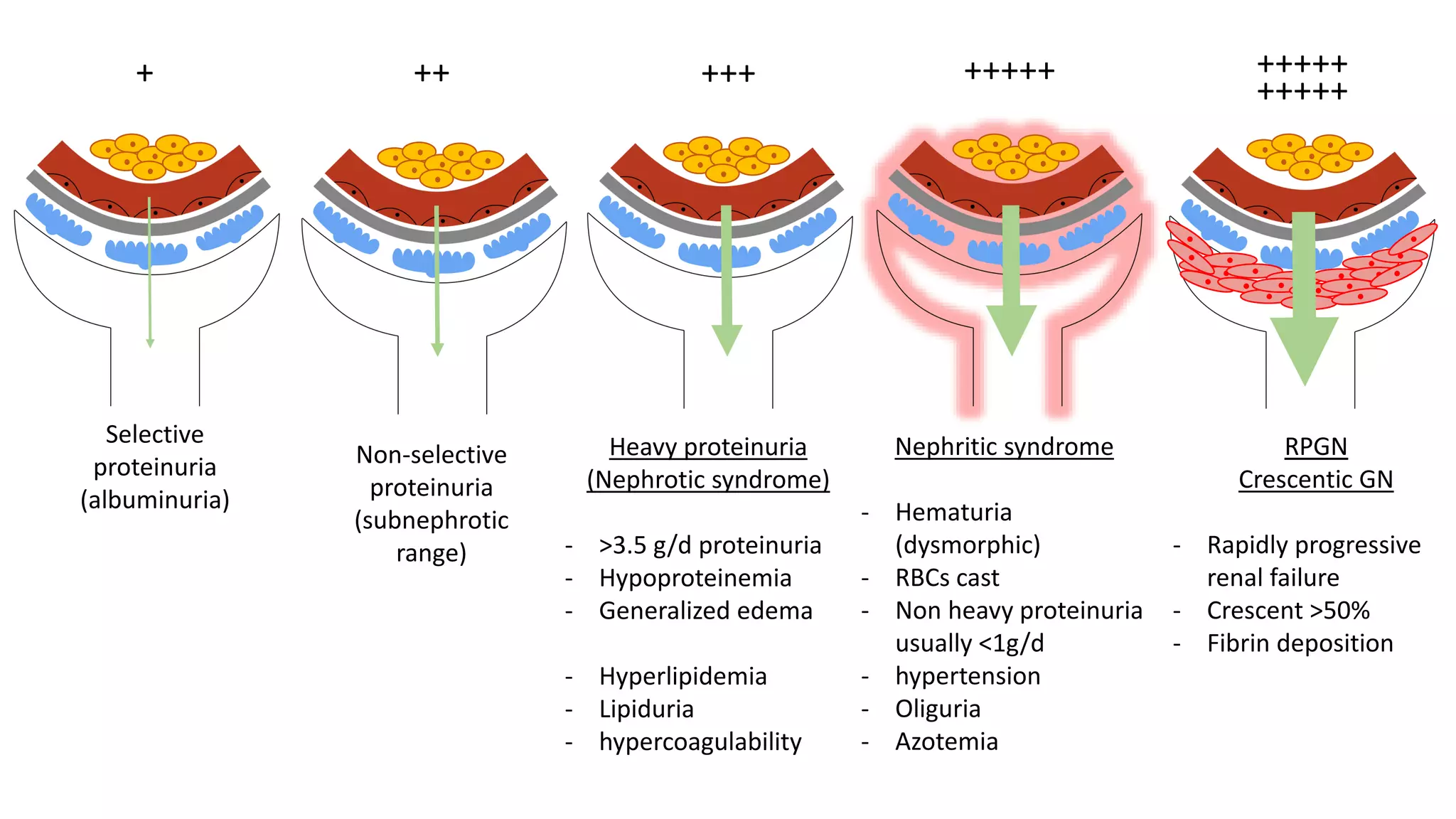 + ++ +++ +++++ +++++
+++++
Selective
proteinuria
(albuminuria)
Non-selective
proteinuria
(subnephrotic
range)
Heavy proteinuria
(Nephrotic syndrome)
- >3.5 g/d proteinuria
- Hypoproteinemia
- Generalized edema
- Hyperlipidemia
- Lipiduria
- hypercoagulability
Nephritic syndrome
- Hematuria
(dysmorphic)
- RBCs cast
- Non heavy proteinuria
usually <1g/d
- hypertension
- Oliguria
- Azotemia
RPGN
Crescentic GN
- Rapidly progressive
renal failure
- Crescent >50%
- Fibrin deposition
 