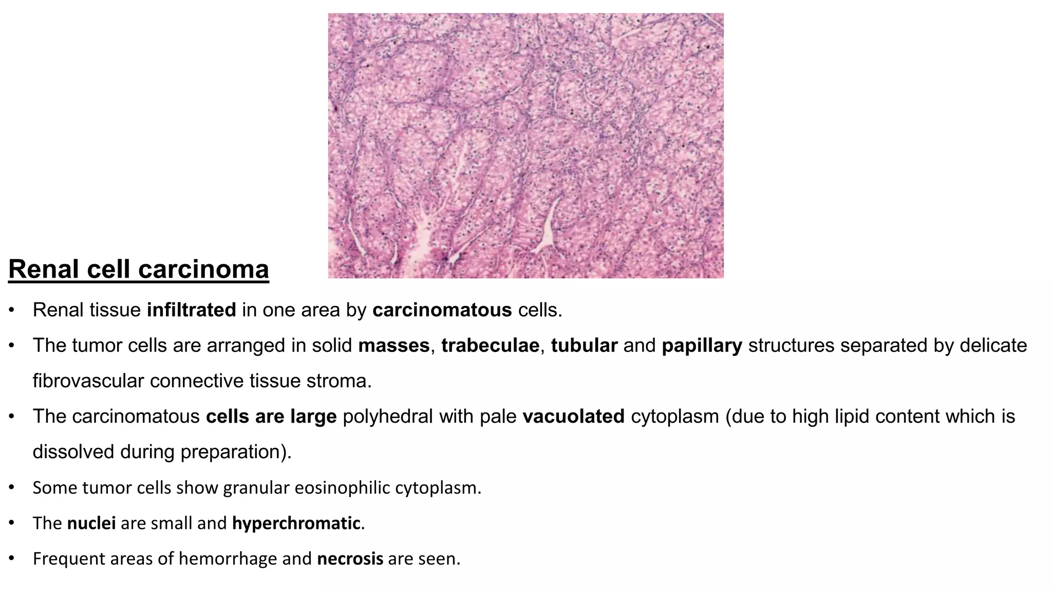 Renal cell carcinoma
• Renal tissue infiltrated in one area by carcinomatous cells.
• The tumor cells are arranged in solid masses, trabeculae, tubular and papillary structures separated by delicate
fibrovascular connective tissue stroma.
• The carcinomatous cells are large polyhedral with pale vacuolated cytoplasm (due to high lipid content which is
dissolved during preparation).
• Some tumor cells show granular eosinophilic cytoplasm.
• The nuclei are small and hyperchromatic.
• Frequent areas of hemorrhage and necrosis are seen.
 