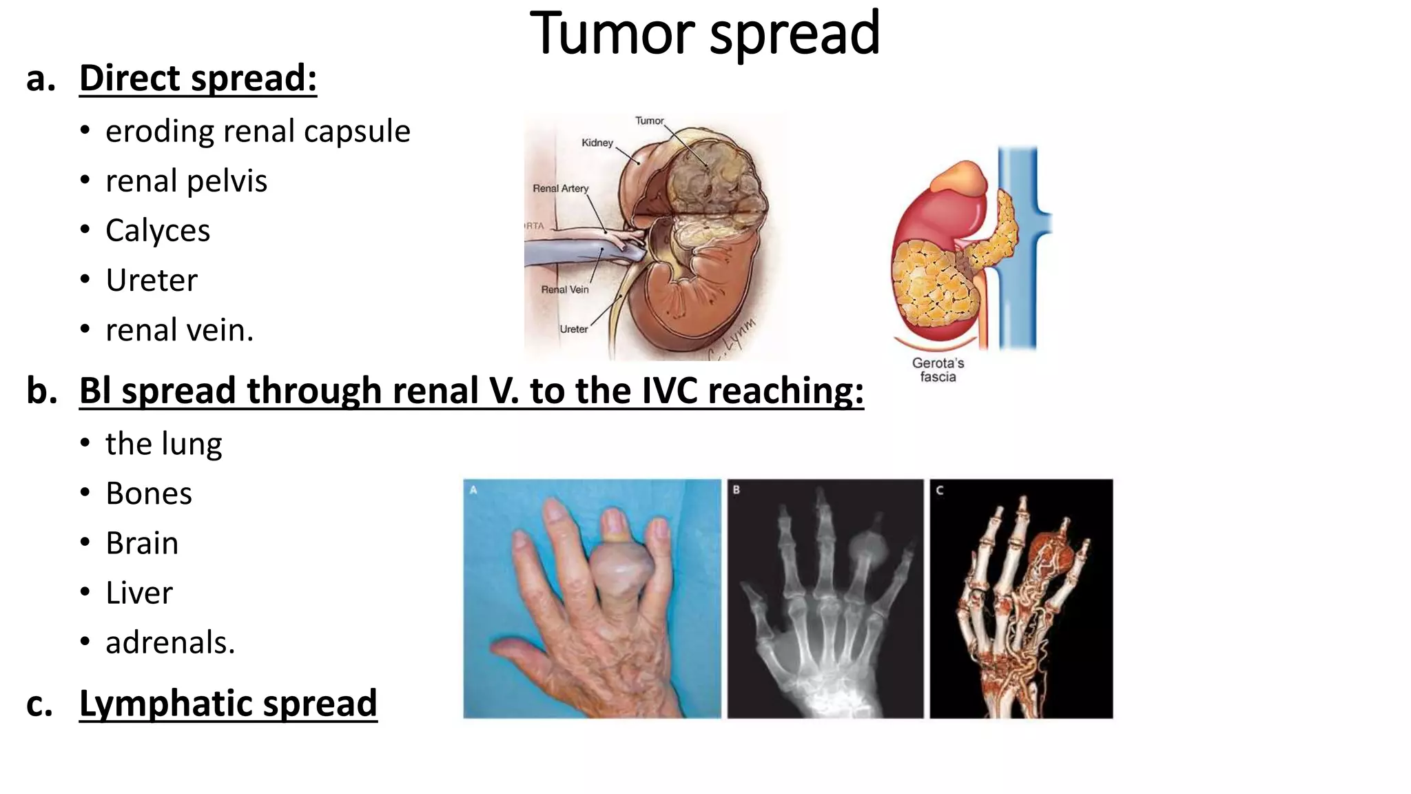 a. Direct spread:
• eroding renal capsule
• renal pelvis
• Calyces
• Ureter
• renal vein.
b. Bl spread through renal V. to the IVC reaching:
• the lung
• Bones
• Brain
• Liver
• adrenals.
c. Lymphatic spread
Tumor spread
 