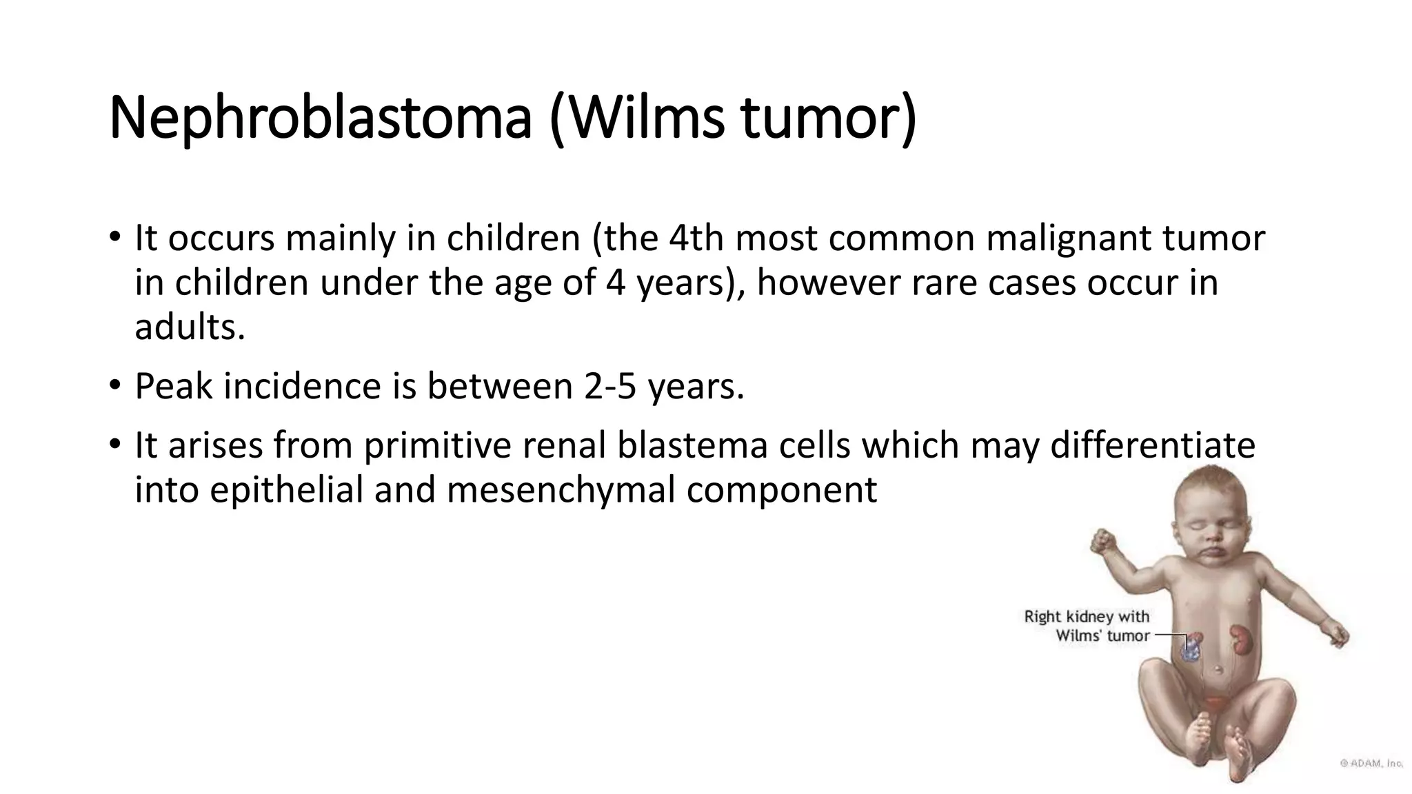 Nephroblastoma (Wilms tumor)
• It occurs mainly in children (the 4th most common malignant tumor
in children under the age of 4 years), however rare cases occur in
adults.
• Peak incidence is between 2-5 years.
• It arises from primitive renal blastema cells which may differentiate
into epithelial and mesenchymal component
 