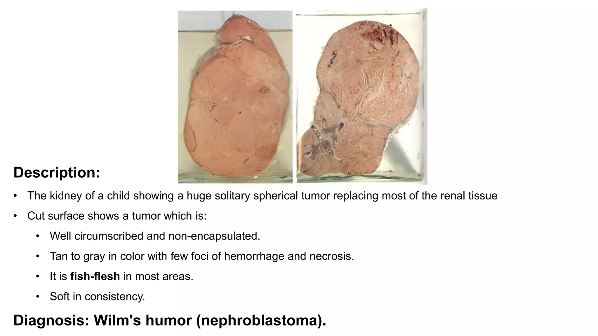 Description:
• The kidney of a child showing a huge solitary spherical tumor replacing most of the renal tissue
• Cut surface shows a tumor which is:
• Well circumscribed and non-encapsulated.
• Tan to gray in color with few foci of hemorrhage and necrosis.
• It is fish-flesh in most areas.
• Soft in consistency.
Diagnosis: Wilm's humor (nephroblastoma).
 
