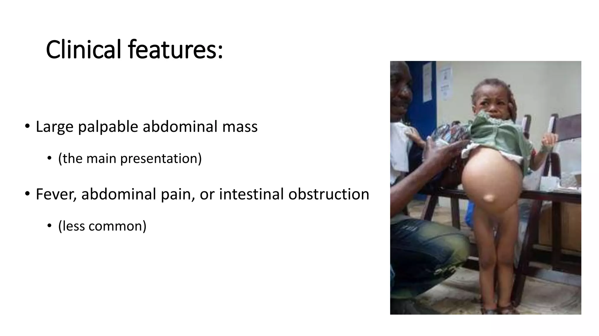 Clinical features:
• Large palpable abdominal mass
• (the main presentation)
• Fever, abdominal pain, or intestinal obstruction
• (less common)
 
