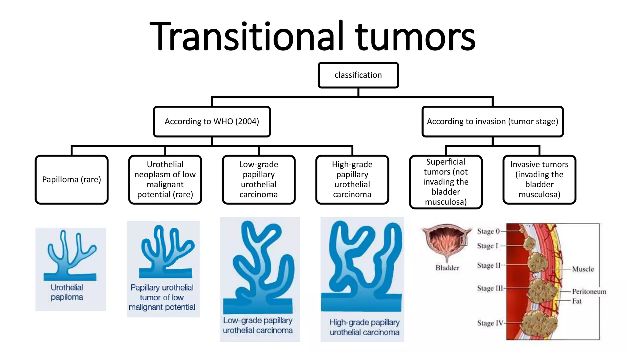classification
According to WHO (2004)
Papilloma (rare)
Urothelial
neoplasm of low
malignant
potential (rare)
Low-grade
papillary
urothelial
carcinoma
High-grade
papillary
urothelial
carcinoma
According to invasion (tumor stage)
Superficial
tumors (not
invading the
bladder
musculosa)
Invasive tumors
(invading the
bladder
musculosa)
Transitional tumors
 