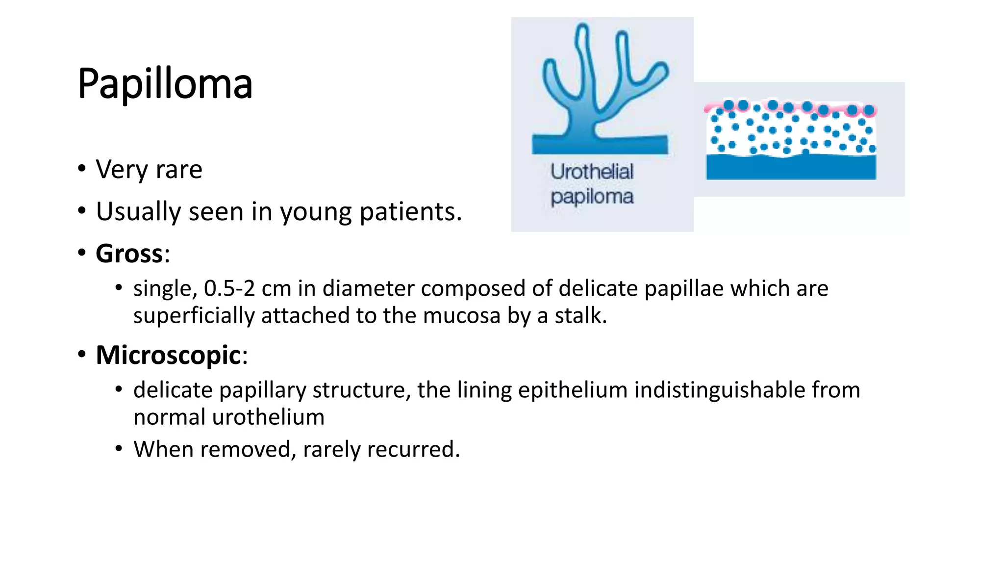 Papilloma
• Very rare
• Usually seen in young patients.
• Gross:
• single, 0.5-2 cm in diameter composed of delicate papillae which are
superficially attached to the mucosa by a stalk.
• Microscopic:
• delicate papillary structure, the lining epithelium indistinguishable from
normal urothelium
• When removed, rarely recurred.
 