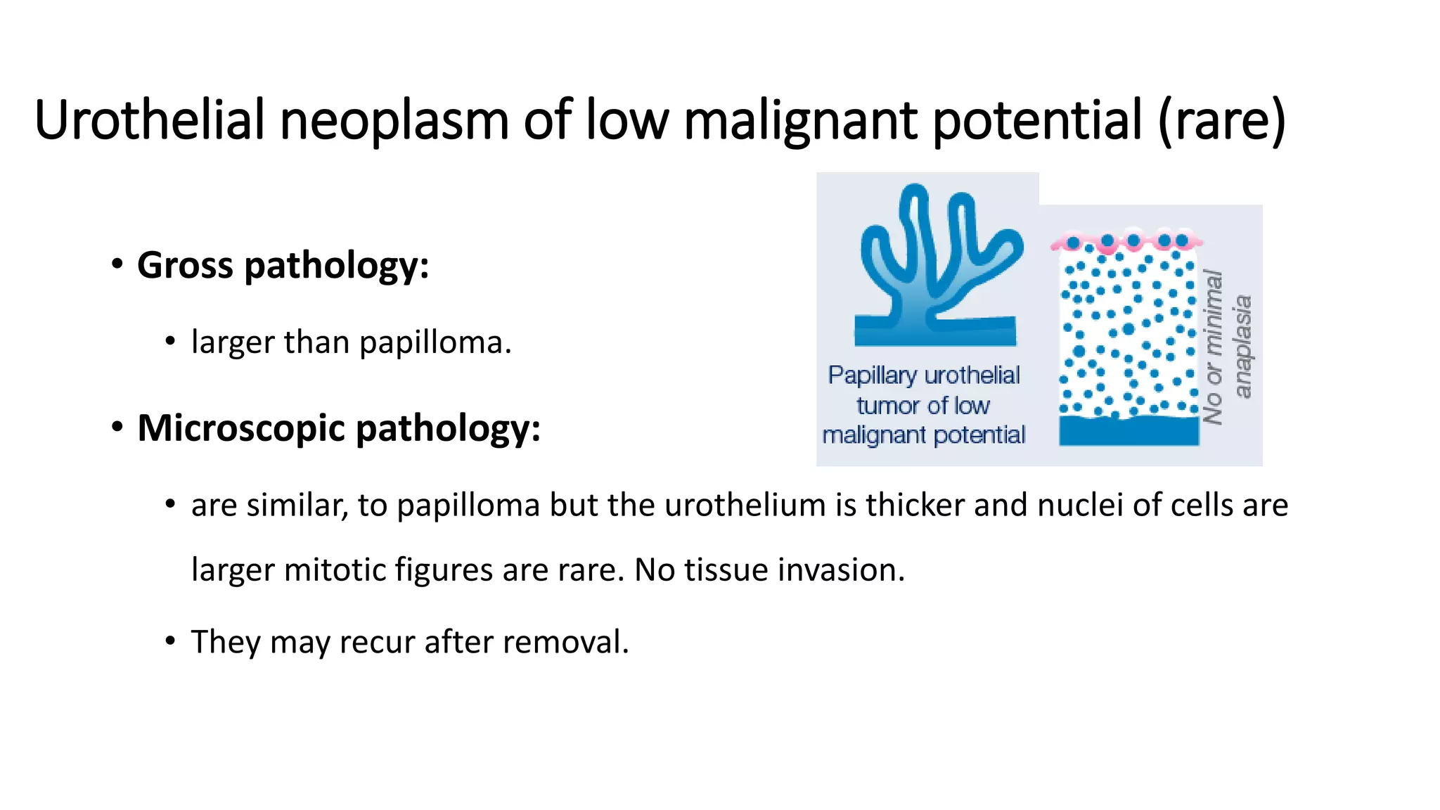 Urothelial neoplasm of low malignant potential (rare)
• Gross pathology:
• larger than papilloma.
• Microscopic pathology:
• are similar, to papilloma but the urothelium is thicker and nuclei of cells are
larger mitotic figures are rare. No tissue invasion.
• They may recur after removal.
 